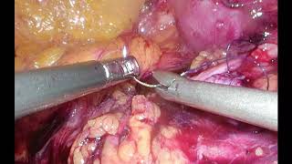 Right Laparoscopic Pyeloplasty - Unedited