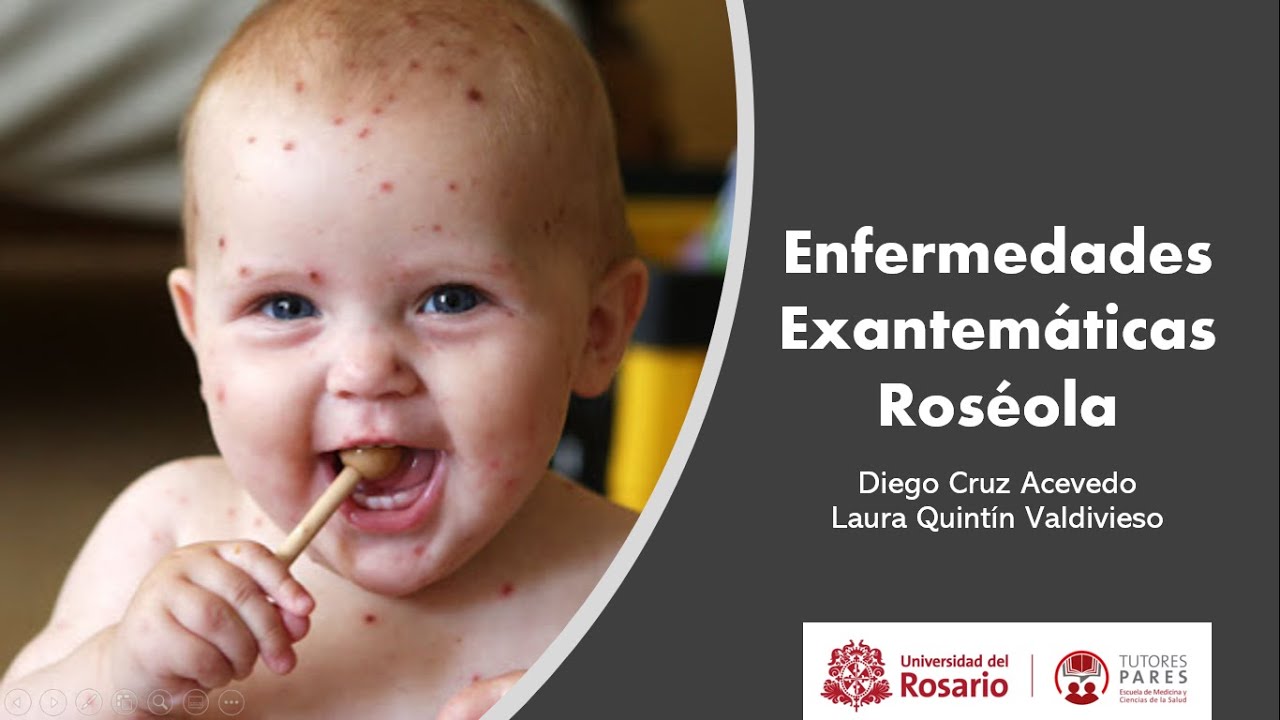 Exantema Subito Exantema Súbito Roséola Infantil O Sexta