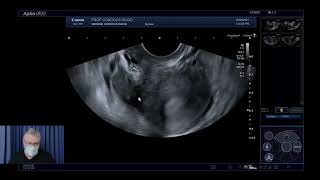 Canon Medical - Prof. Condous - Live Scan - Demonstration Endometriosis Ultrasound Imaging