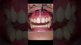 Immediate Fix for GAPS OR SPACES for your front teeth/ DIASTEMA CLOSURE/COSMETIC RESTORATION #shorts