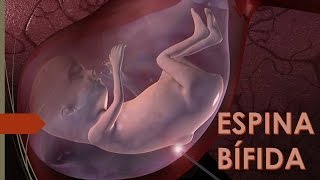 Mielomeningocele (Espina Bifida) Recomendaciones de Fisioterapia.