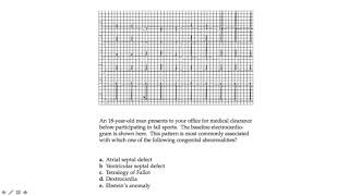 Algorithm 31 : Tachycardia