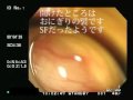 大腸内視鏡検査　typec no.5　colonoscopy