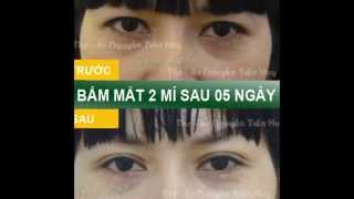 Hình ảnh kết quả bấm mắt 2 mí Dove Eyes hàn quốc sau 5 ngày.