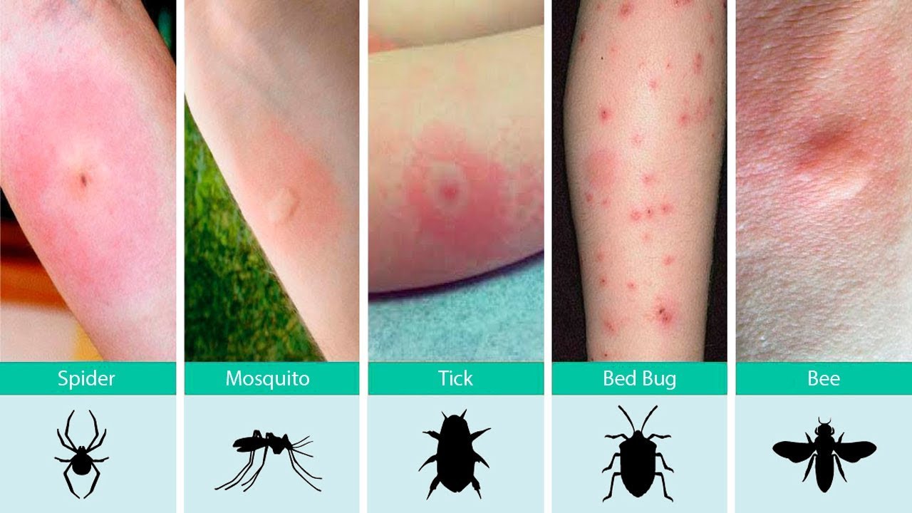Ouch What Bit Me How To Identify Common Bug Bites And What To Do Ouch What Bit Me How To Identify Common Bug Bites And What To Do
