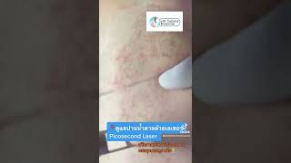 รักษาปานน้ำตาลด้วยเลเซอร์ Picosecond Laser  หมอรุจชวนคุย ปานดำ ปานแต่กำเนิด