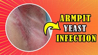 How to treat Armpit yeast infection (Candida) at home