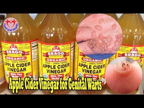 Apple Cider Vinegar for Genital Warts |Food and Health Apple Cider Vinegar for Genital Warts |Food and Health