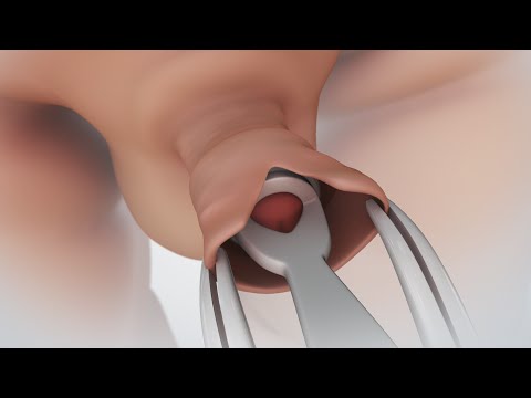 What does healing circumcision look like?