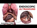 Endoscopic Ultrasound EUS | Animated Video