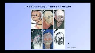 Ageing and Alzheimer’s disease: the search for the cure