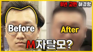 M자 탈모 완벽 커버 헤어스타일 추천! 8년 컴플렉스 해결했습니다! [클래씨] #263