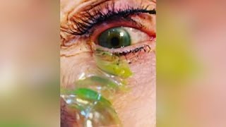 Doctor removes 23 contact lenses from patient's eye