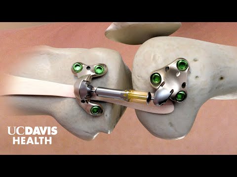 What is the main shock absorber in the knee?