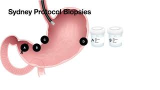 Gastroscopy -Sydney Protocol Biopsies