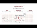 hypokalemia and hyperkalemia ecg changes