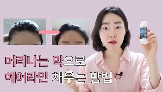 헤어라인 고민인 분들 주목! 탈모가 아닌데 탈모약을 바르는 이유 | 미녹시딜 4개월 사용 후기 (cc자막)