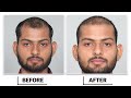 hair transplant in ulhasnagar best results u0026 cost of hair transplant in ulhasnagar