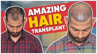 Hair Transplant in Ulhasnagar | Best Results \u0026 Cost of Hair Transplant in Ulhasnagar