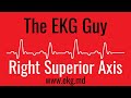 Right Superior Axis on EKG / ECG l The EKG Guy - www.ekg.md