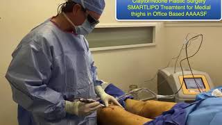 SmartLipo video