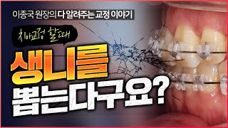 발치교정 진단 받으신 분들을 위한 영상]  생니를 뽑는다고요??