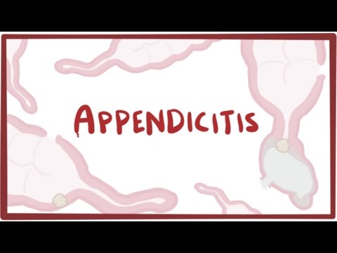 Appendicitis - causes, symptoms, diagnosis, treatment & pathology Appendicitis - causes, symptoms, diagnosis, treatment & pathology