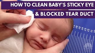 How to clean a baby's sticky eye and blocked tear duct