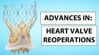 Advances in Heart Valve Reoperations Webinar with Dr. Charles Davidson \u0026 Dr. Christopher Mehta