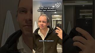 Hair Transplant Results: What Happens in the First 18 Days? (Shocking!)