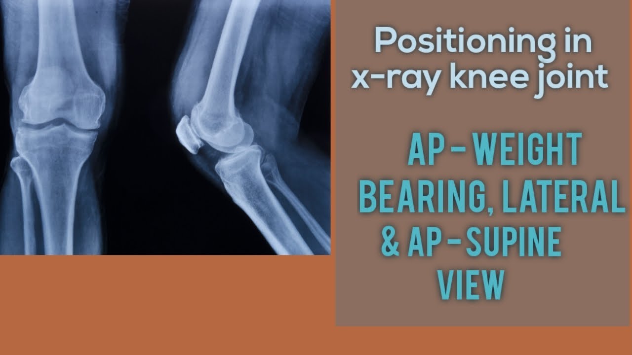 X Ray Knee Joint Ap Lateral View | X Ray Knee Standing | X Ray Knee ...