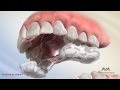 Orthodontic Expander or Spacer - Bonded RPE Appliance