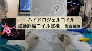 ハイドロジェルコイル 脳動脈瘤塞栓 術者目線 Hydro-gel coil