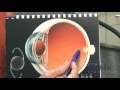 Part 3: Cataract Surgery (Max HD implant with Blended Vision)