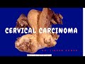 CERVICAL CARCINOMA II FGT II ROBBINS 10TH E II PATHOLOGY LECTURES