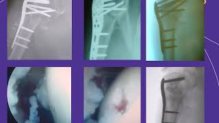 Avoiding Complications for Locked Plating for Proximal Humerus Fractures   VuMedi