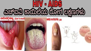 ಎಚ್ಐವಿ ಕಾಯಿಲೆಯ ರೋಗ ಲಕ್ಷಣಗಳು/ hiv symptoms in Kannada