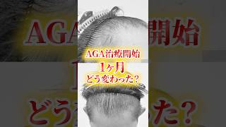 【薄毛】AGA治療の経過