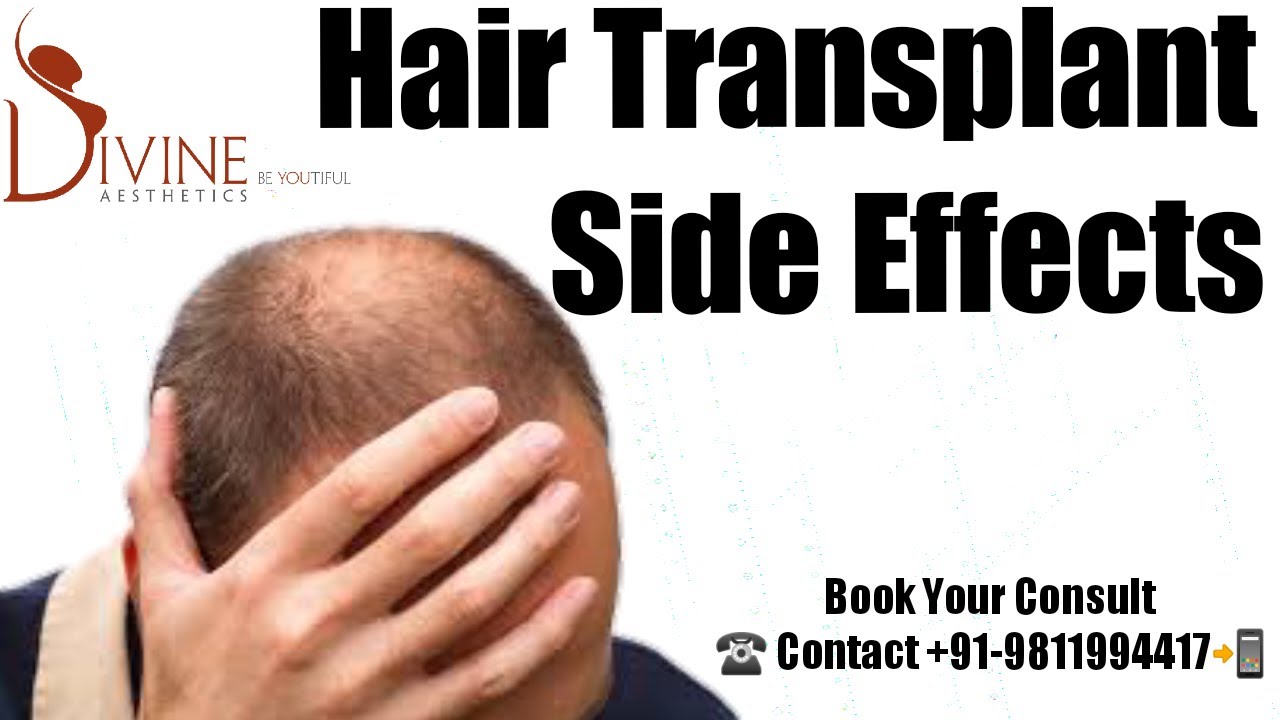 Hair Transplant Side Effects | Hair Transplant | India's Most Trusted ...