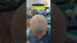 UNBELIEVABLE HAIR TRANSPLANT RESULT IN INDIA ||#shorts