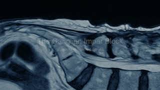 PainExam US Guided Ganglion Impar Block:  Coccygodynia, Pelvic \u0026 Perineal Pain: David Rosenblum, MD