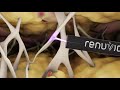 renuvion cosmetic technology animation