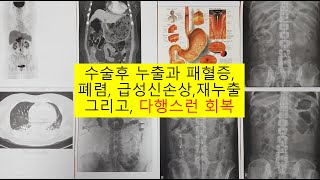 [외과의사] 수술후 위장천공, 패혈증, 폐렴, 급성신손상, 재누출 그리고 다행스런 회복