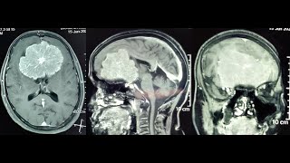 GIANT OLFACTORY GROOVE-ANTERIOR SKULL BASE - MENINGIOMA -MICROSURGERY-dr suresh dugani/HUBLI/INDIA