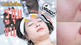 。 Vlog +รีวิว 。 เข้าคลินิกแก้รูขุมขนกว้าง..ผิวแห้ง | Miracle Repair Cocktail || PEAR SILK 👁