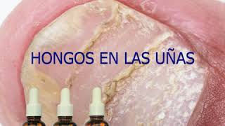 5 Problemas Tratados Con Aceites Ozonizados