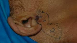 earlobe Reconstruction