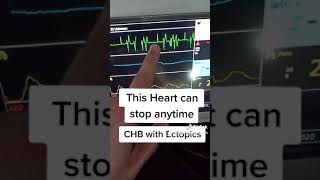 Complete Heart block with Ectopic beats | Quick Health Tips by Dr.Paramjeet