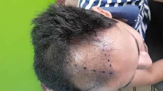 3250 grafts FUE Hair Transplant by Dr.Sreenath at Hair O Dent