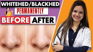 ब्लैकहेड्स ख़त्म करने के असरदार नुस्खे | how to remove blackheads at home in hindi | Dr Suman